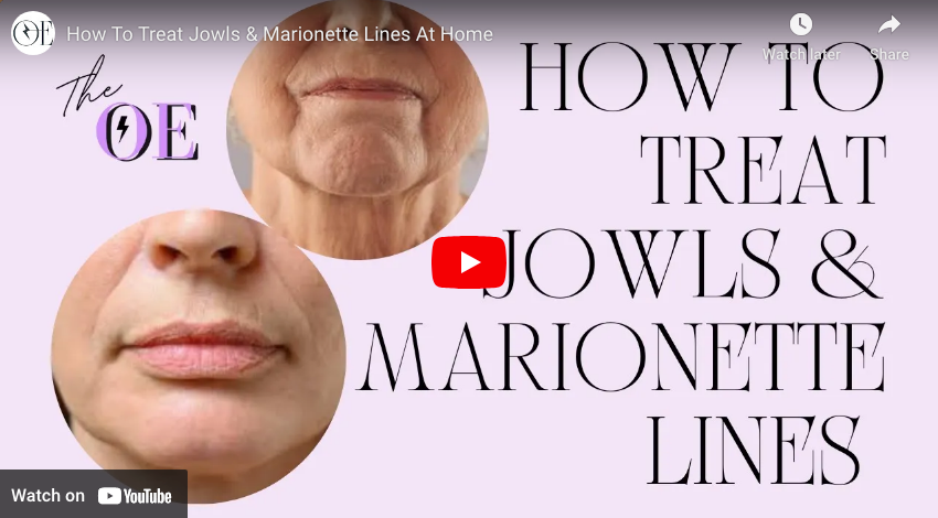 Jowls & Marionette Lines